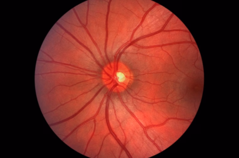 Laser Eye Treatments in Laguna Hills and Santa Ana